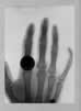 bragg-hand-xray